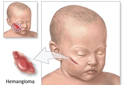 Hemangioma