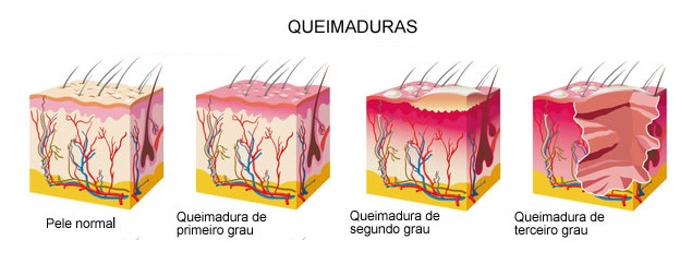 queimaduras