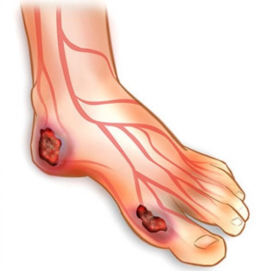Úlceras em pé diabético: conheça causas e como tratar