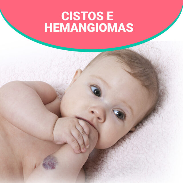 Conheça as características que tornam cistos e hemangiomas diferentes