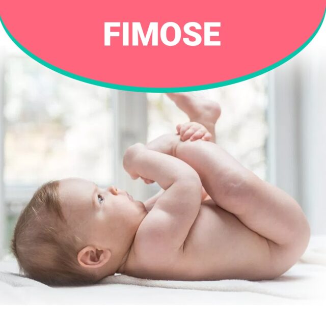 Fimose: o que é, diagnóstico e como tratar