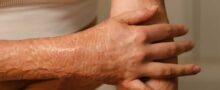 Cicatriz de Queimadura - O que é e como fazer para tratar?