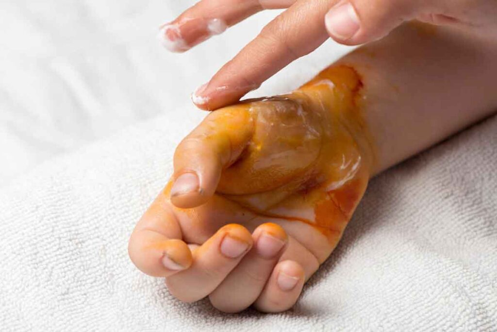 Graus de queimadura (1º, 2º e 3º): como identificar e tratar cada um