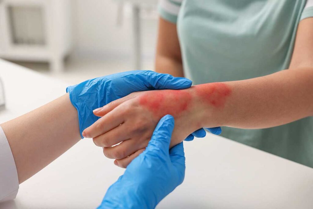 Desospitalização no tratamento de queimaduras e feridas: Mais conforto na recuperação